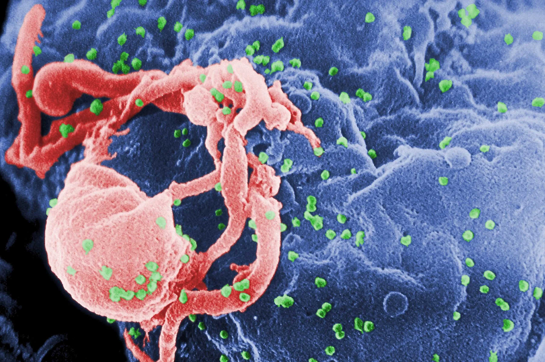 HIV scare at THQ Hospital Mian Channu: 69 dialysis patients being screened